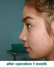 plastic_surgery_augmentation_rhinoplasty